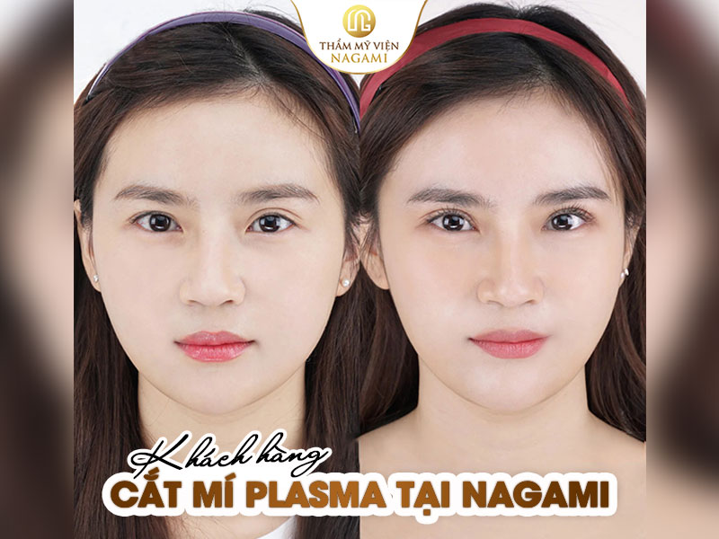 Hình ảnh khách hàng trước và sau khi cắt mí Plasma tại Nagami