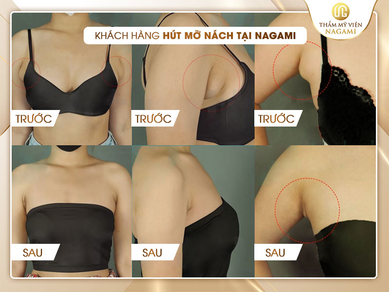 Hình ảnh thực tế khách hàng sau khi thực hiện hút mỡ dưới nách