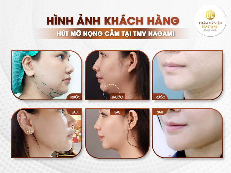 Hình ảnh khách hàng sau khi thực hiện hút mỡ nọng cằm