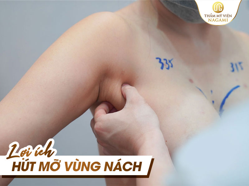 Lợi ích khi thực hiện hút mỡ dưới nách