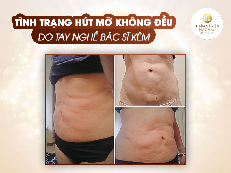 Hút mỡ bụng không đều, do tay nghề bác sĩ yếu kém