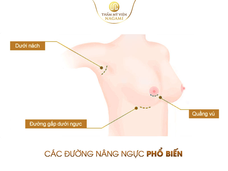 Các đường nâng ngực phổ biến, chị em có thể tham khảo cho phù hợp