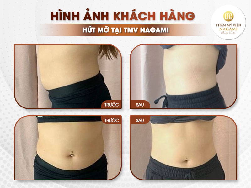 Hình ảnh trước và sau khi hút mỡ bụng tại Nagami