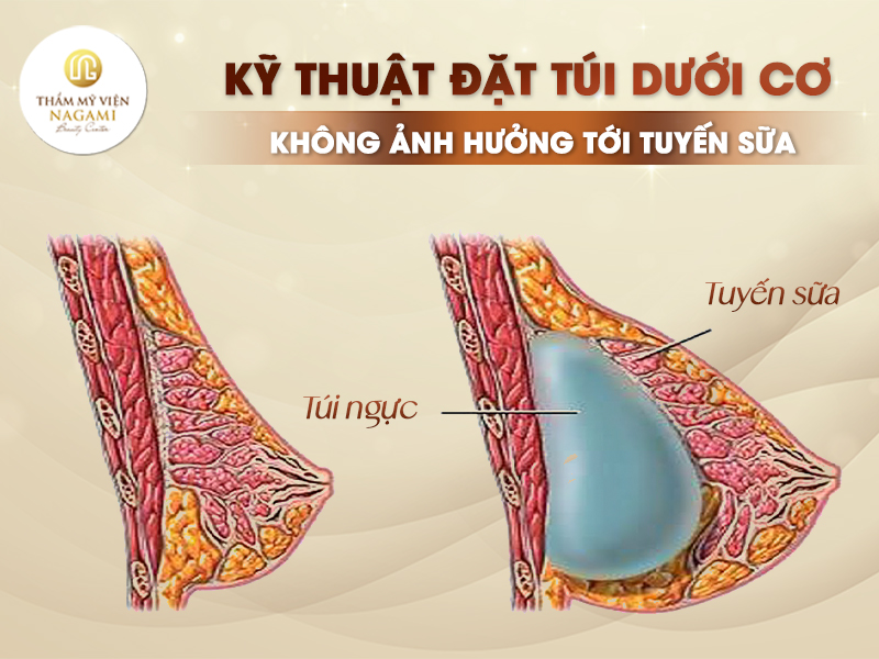 Nâng ngực đặt túi dưới cơ không ảnh hưởng đên tuyến sữa