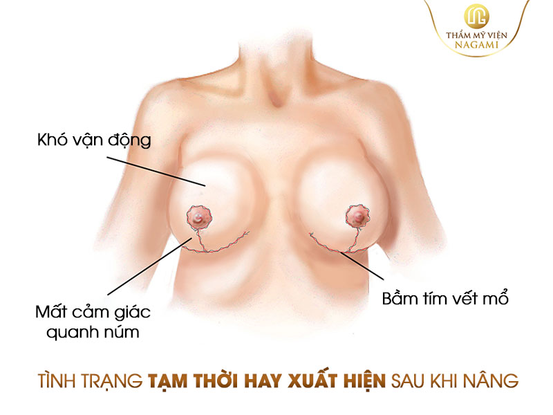 1 số tình trạng tạm thời xuất hiện, sau khi nâng ngực