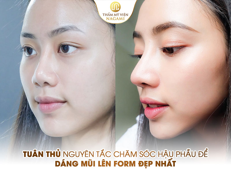 Hình ảnh trước và sau khi nâng mũi của khách hàng