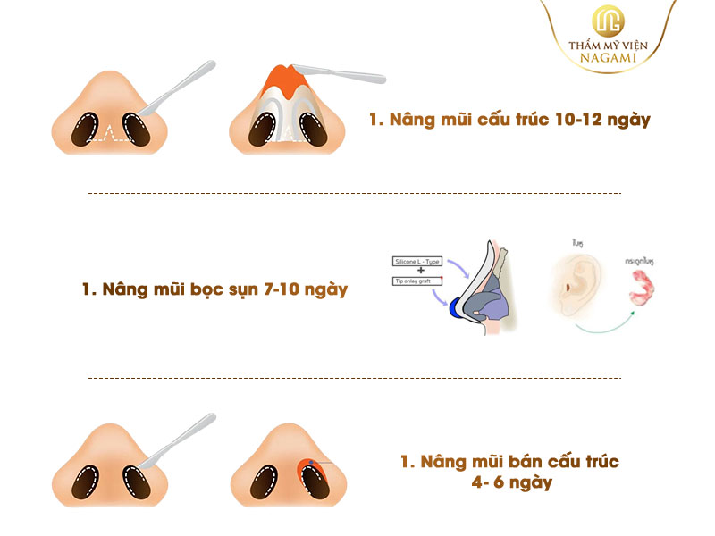 Tùy từng phương pháp sẽ có thời gian cắt chỉ khác nhau sau nâng mũi