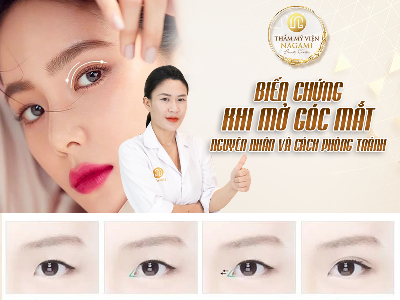 Biến chứng khi mở góc mắt - Nguyên nhân và cách khắc phục