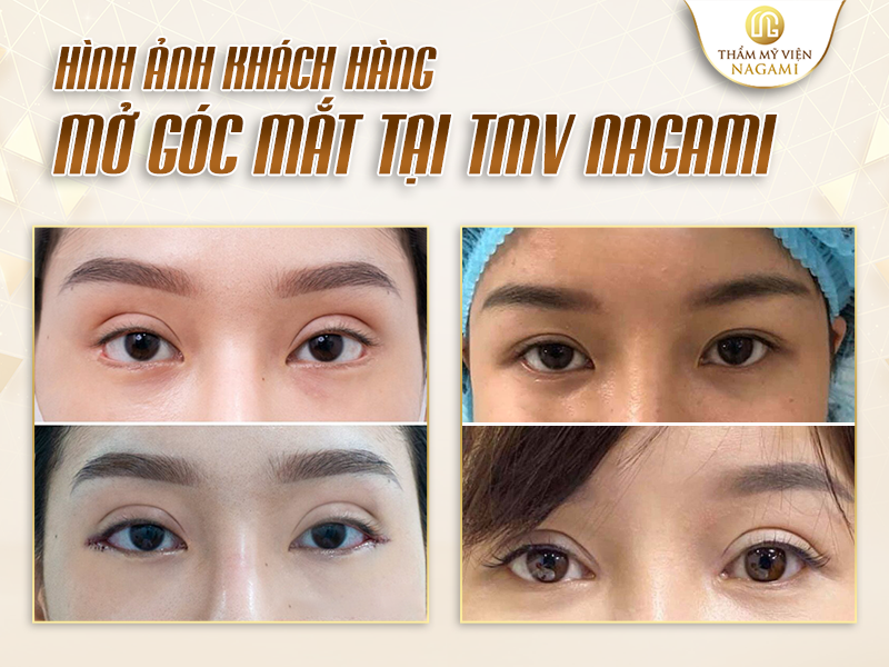 Hình ảnh khách hàng mở góc mắt tại TMV Nagami