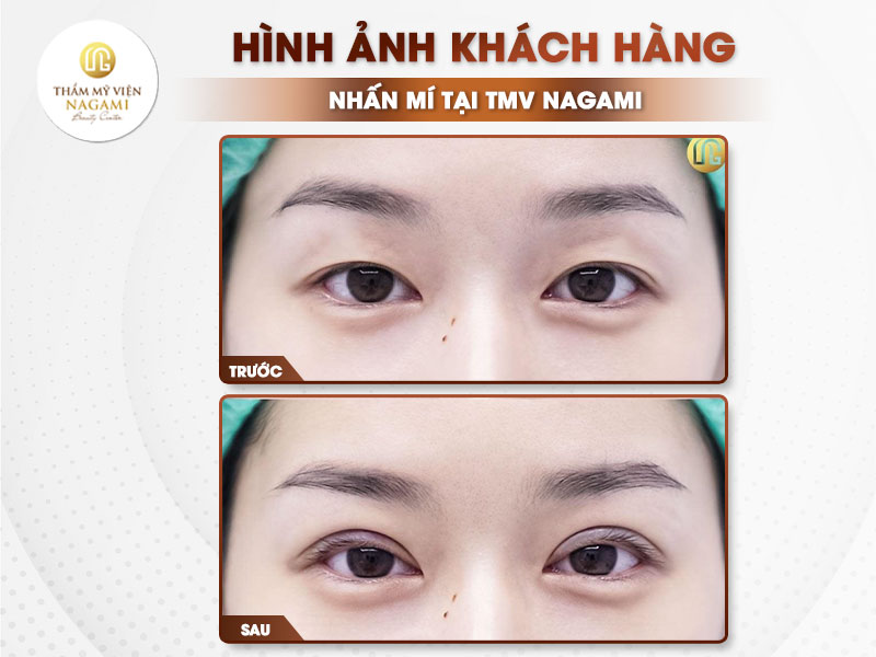 Hình ảnh khách hàng nhấn mí tại TMV Nagami