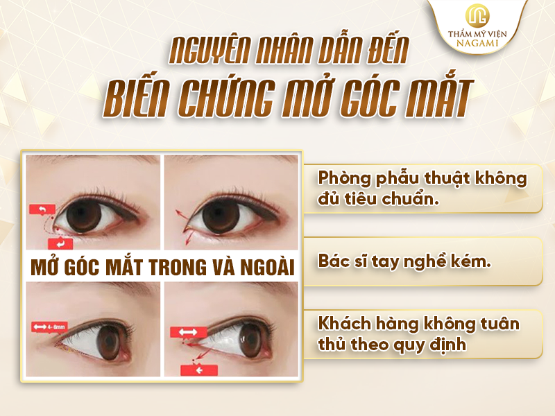Nguyên nhân dẫn đến biến chứng mở góc mắt