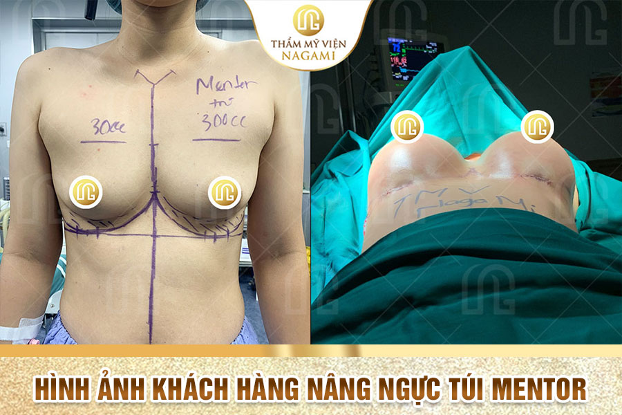 Hình ảnh khách hàng nâng ngực túi Mentor tại TMV Nagami