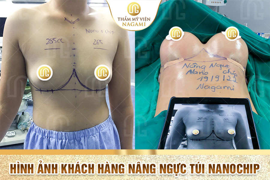 Hình ảnh khách hàng nâng ngực túi Nano chip tại TMV Nagami