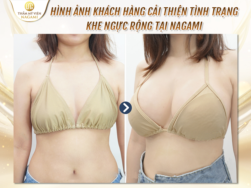 Hình ảnh khách hàng cải thiện tình trạng khe ngực rộng tại Nagami