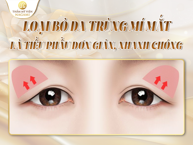 Loại bỏ da chùng mí mắt là tiểu phẫu đơn giản, nhanh chóng