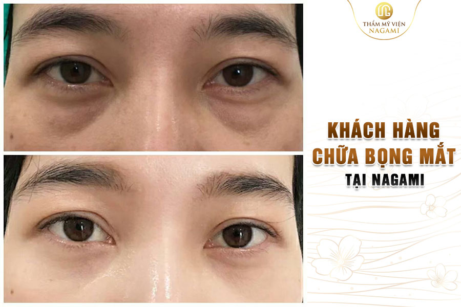 Hình ảnh khách hàng chữa bọng mắt tại Nagami