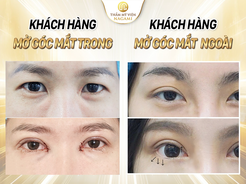 Hình ảnh khách hàng mở góc mắt trong và góc mắt ngoài