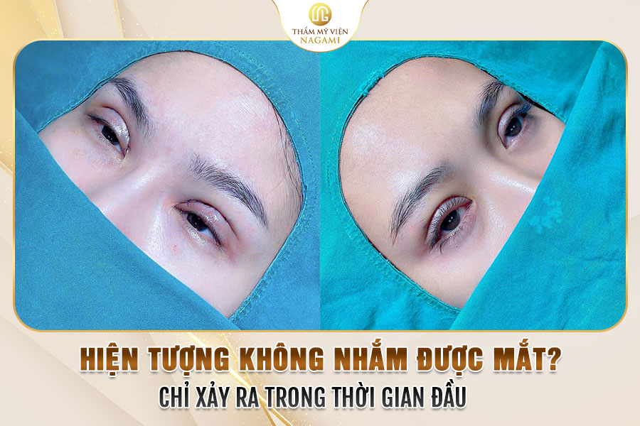 Hiện tượng không nhắm được mắt chỉ xảy ra trong thời gian đầu