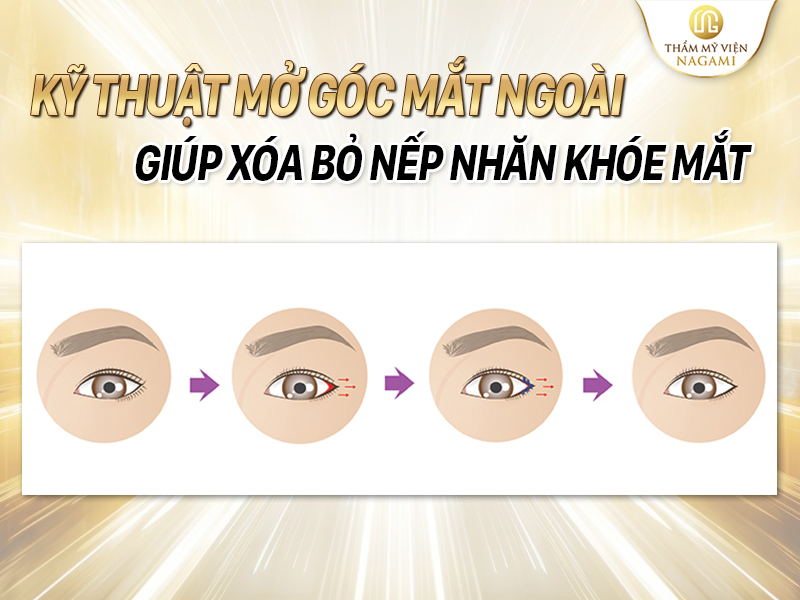 Kỹ thuật mở góc mắt ngoài - Giúp loại bỏ nếp nhăn khóe mắt