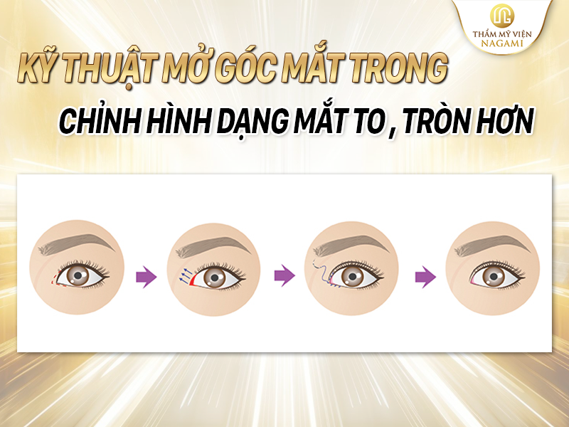 Kỹ thuật mở góc mắt trong - Chỉnh hình dạng mắt to, tròn hơn