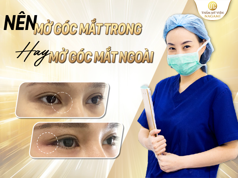 Nên mở góc mắt trong hay mở góc mắt ngoài
