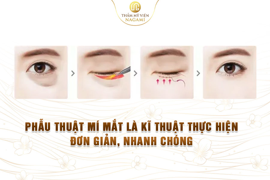 Phẫu thuật mí mắt là kỹ thuật thực hiện đơn giản, nhanh chóng