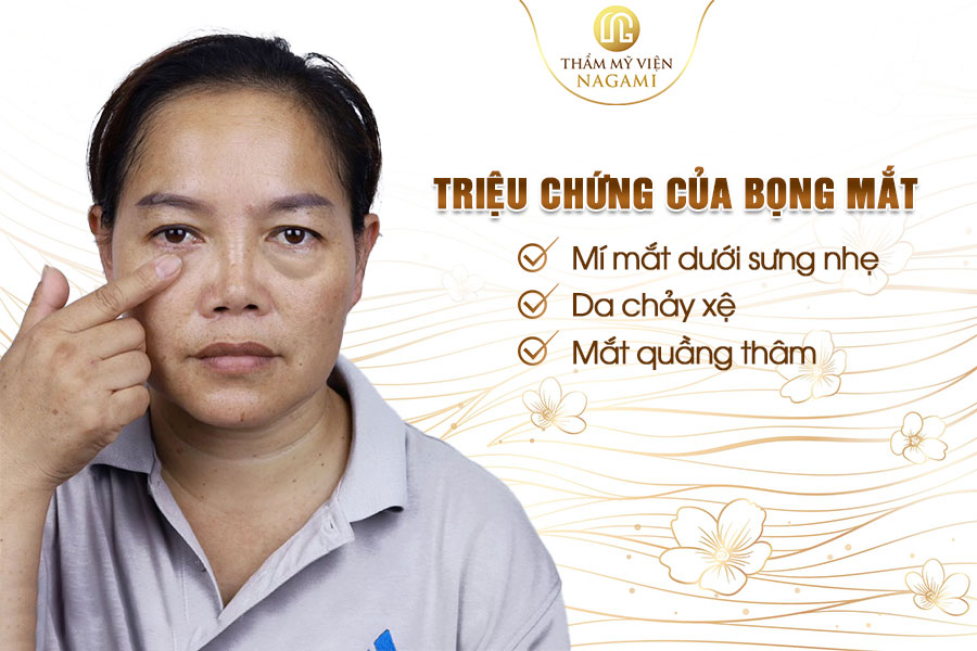 Triệu chứng của bọng mắt