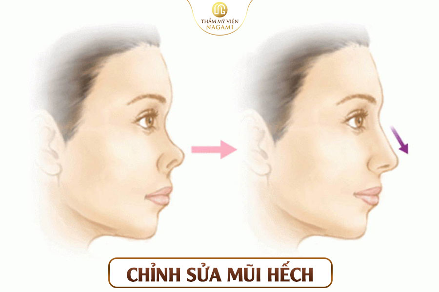 Chỉnh sửa mũi hếch