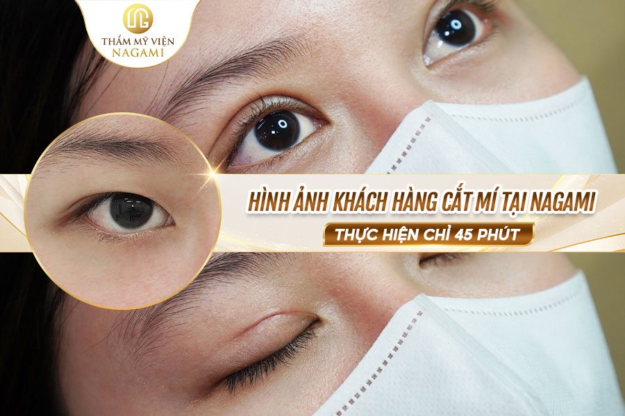 Hình ảnh khách hàng cắt mí tại Nagami