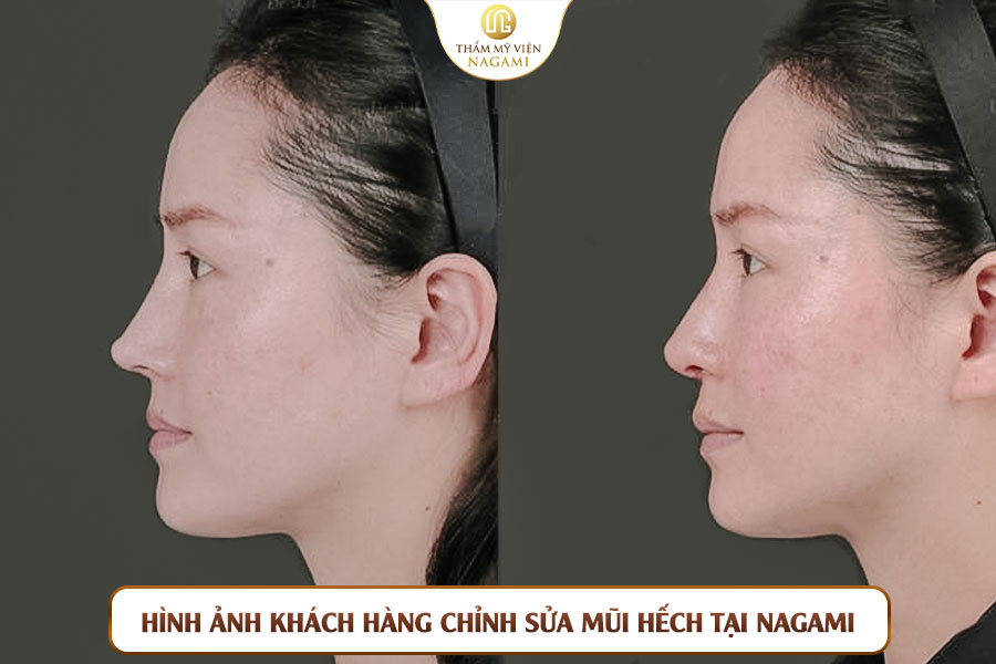 Hình ảnh khách hàng chỉnh sửa mũi hếch tại Nagami