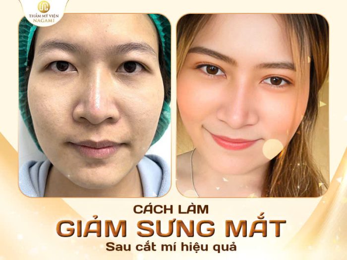 Cách làm giảm sưng mắt sau cắt mí