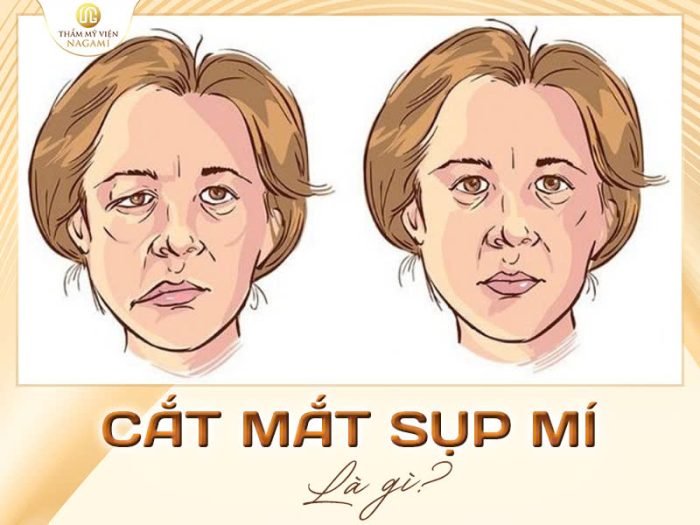 Cắt mắt sụp mí là gì?