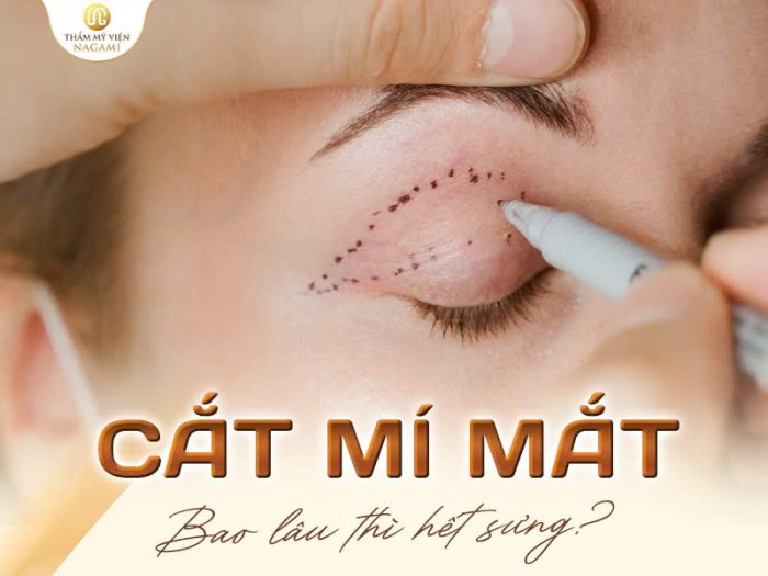 Cắt mí bao lâu hết sưng
