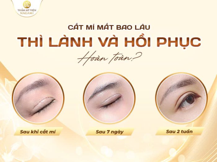 Cắt mí mắt bao lâu thì lành và hồi phục