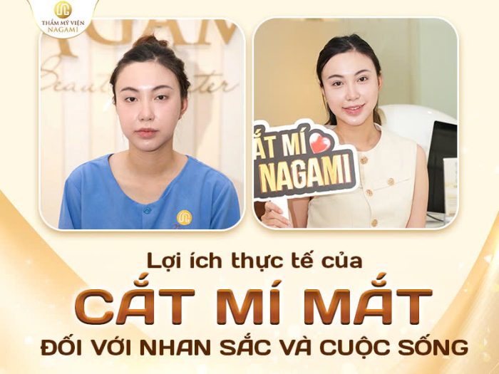 Lợi ích của cắt mí với nhan sắc