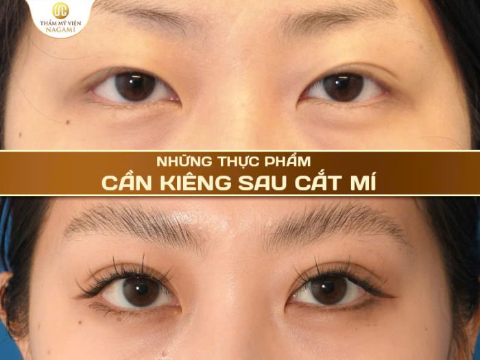 Những thực phẩm cần kiêng sau cắt mí