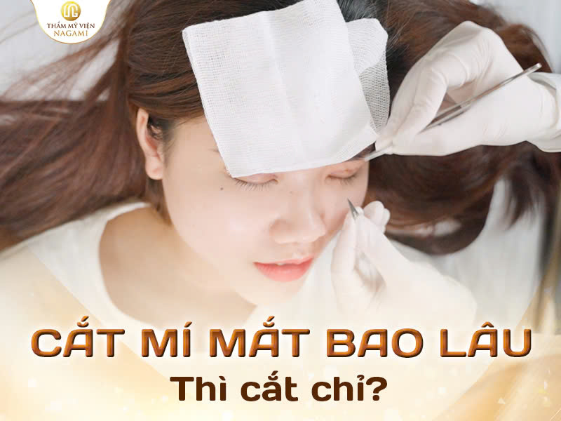 Cắt mí mắt bao lâu thì cắt chỉ