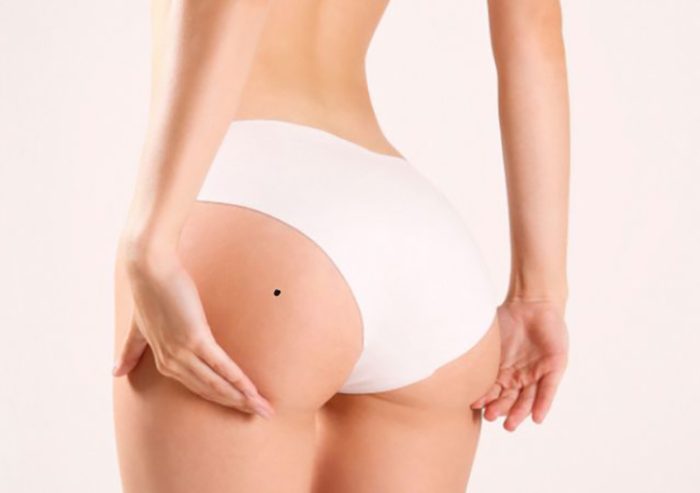 Nốt ruồi ở mông phụ nữ và ý nghĩa