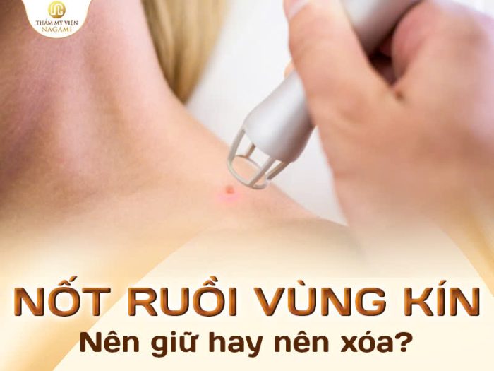 Nốt ruồi ở vùng kín nữ nên giữ hay nên xóa