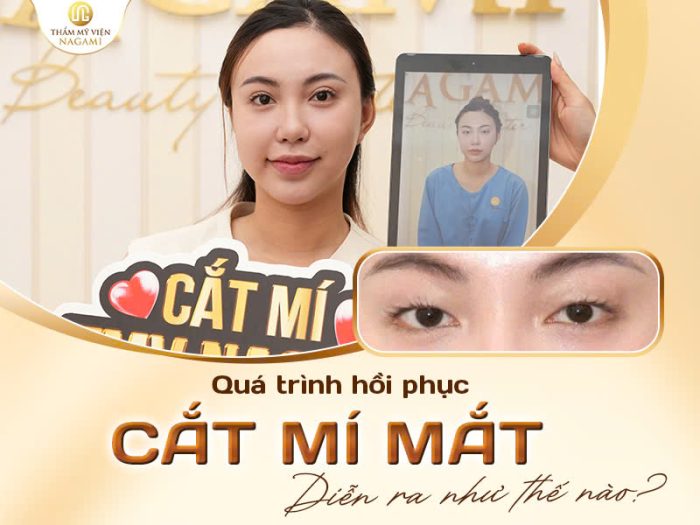 Quá trình hồi phục cắt mí diễn ra như thế nào?