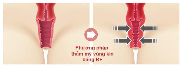 Thẩm mỹ vùng kín không phẫu thuật với sóng RF